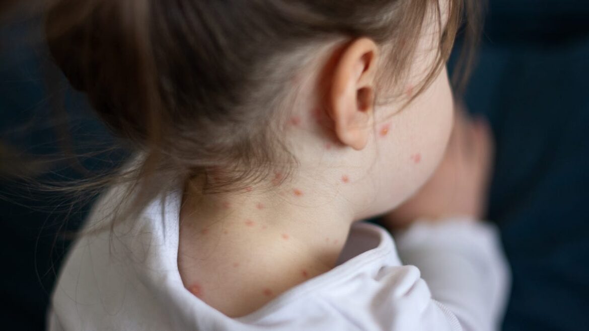 Measles Cluster and Public Exposure Sites