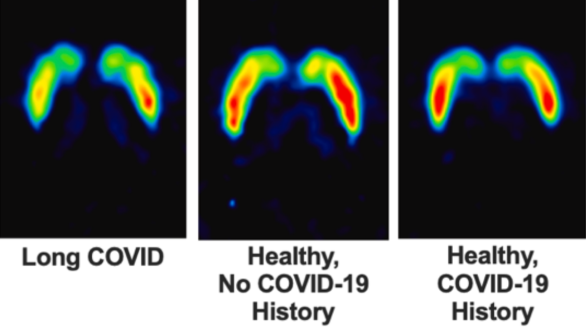 Long COVID Linked to Reduced Dopamine Nerve Endings