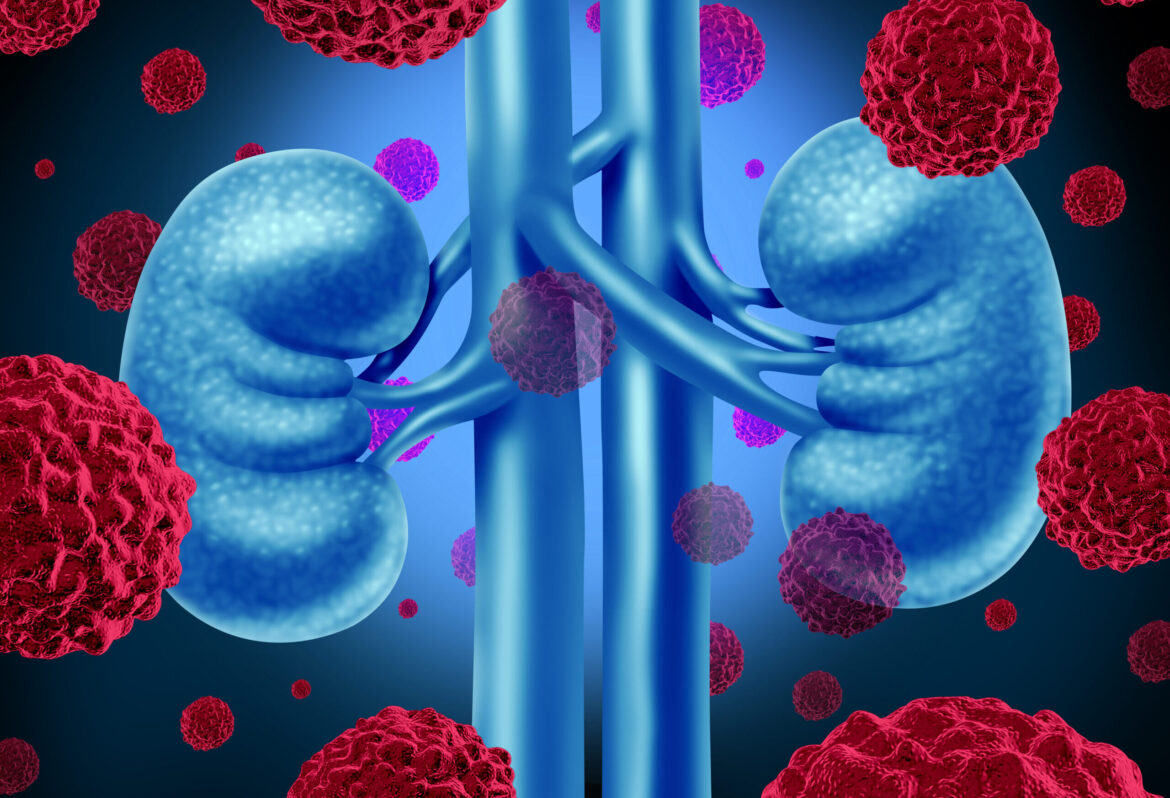 Personalized T-Cell Therapy Induces Complete Remission in Kidney Cancer