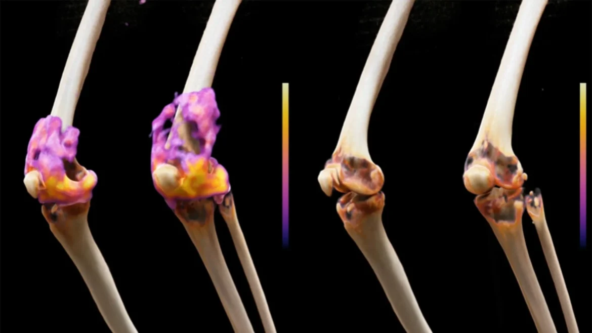 CAR T-Cell Therapy Brings Remission to 6 Patients with Severe Rheumatoid Arthritis