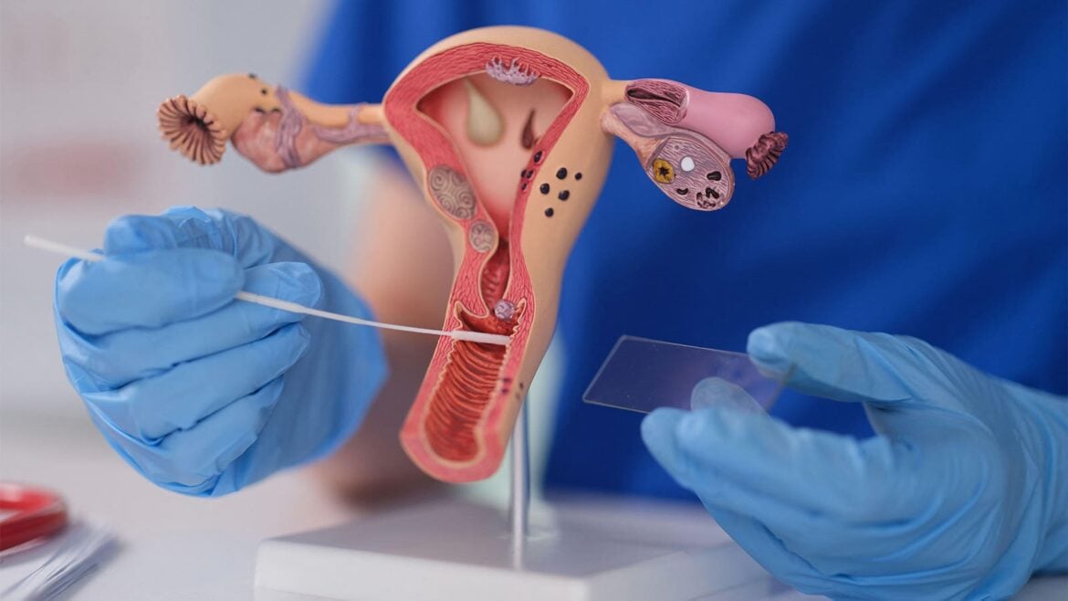 Cervical Cancer Screenings: Nearly 1 in 3 Young US Women Never Screened