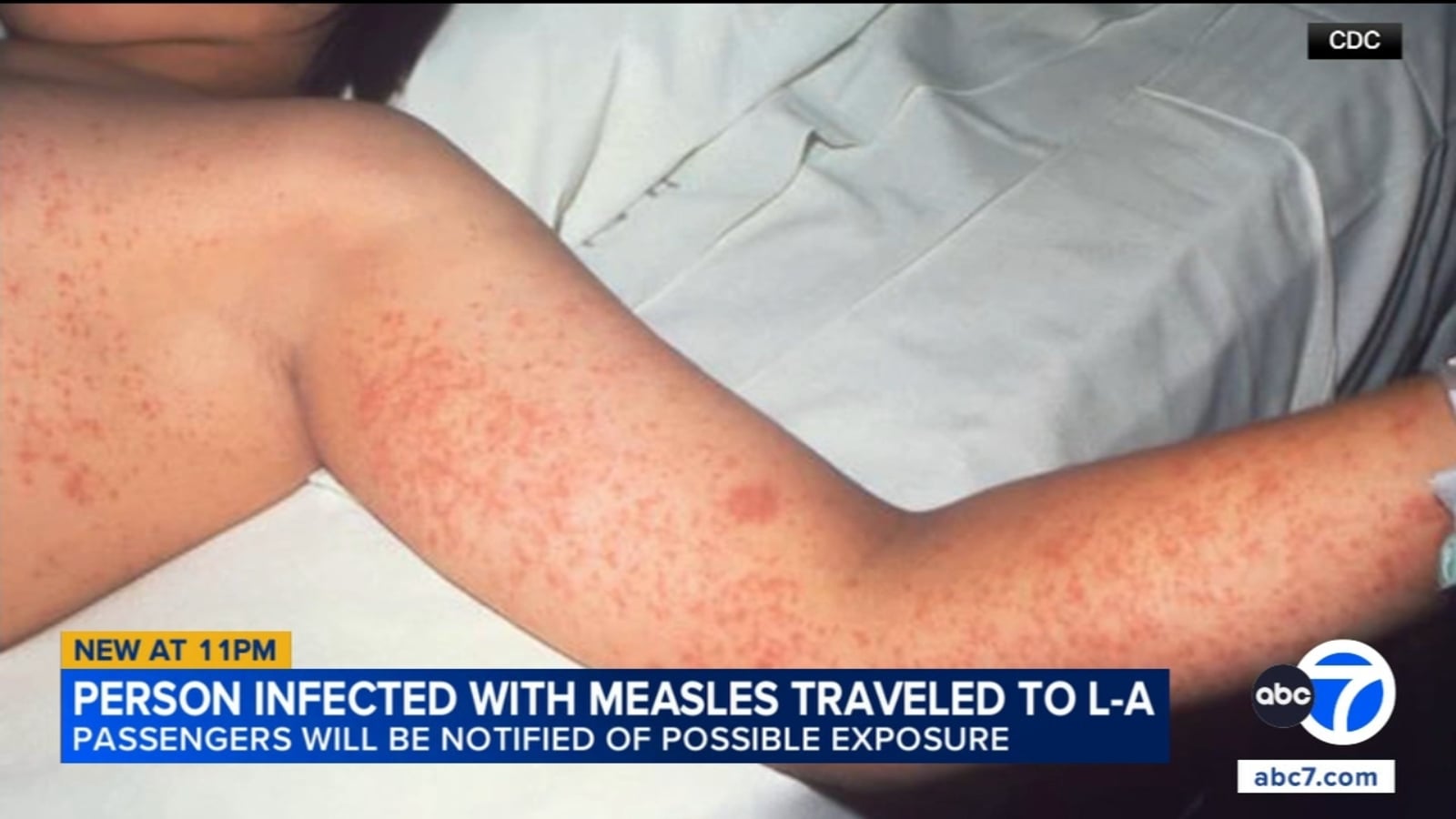 LA Union Station Passengers Potentially Exposed to Measles by Traveler