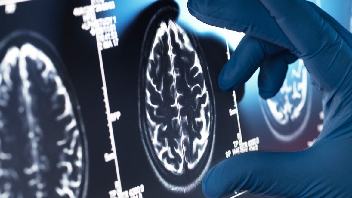 Alzheimer's Neurodegeneration May Be Driven by Immune Cells Outside the Brain