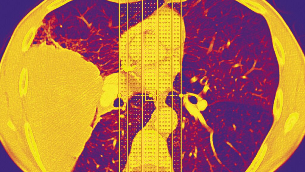 Rare EGFR Variant Raises Lung Cancer Risk 60-Fold in Never-Smokers
