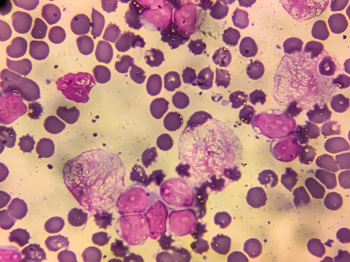 1 in 8 Cancer Cases Worldwide Linked to Infections, Study Finds - Newsweek featured image