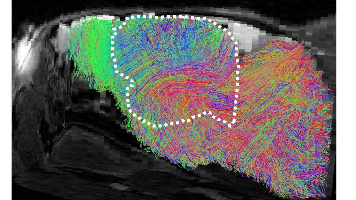 Stanford Researchers Grow Human Brain Tissue in Genetically Modified Mice