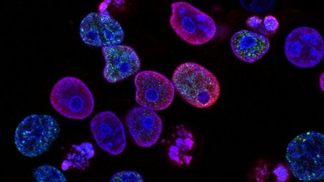 Giant-Nucleus Cells Linked to Early-Stage Cancer and Ferroptosis Resistance