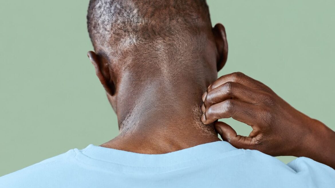 Atopic Dermatitis in Skin of Color: Why Traditional Redness Signs Fall Short