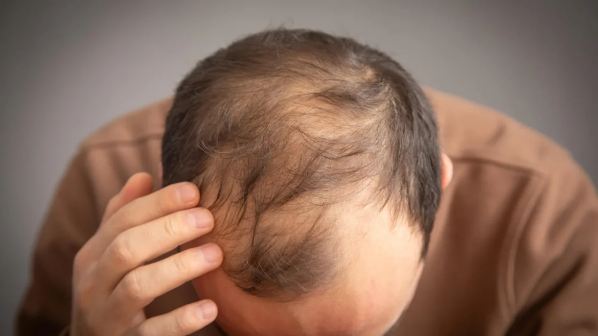 Ozempic Linked to 7% Hair Loss Risk in Men