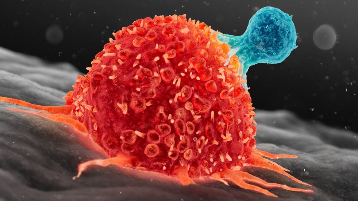 Young Boy's Metastatic Cancer Disappears After Experimental GPC3-CAR T Cell Therapy