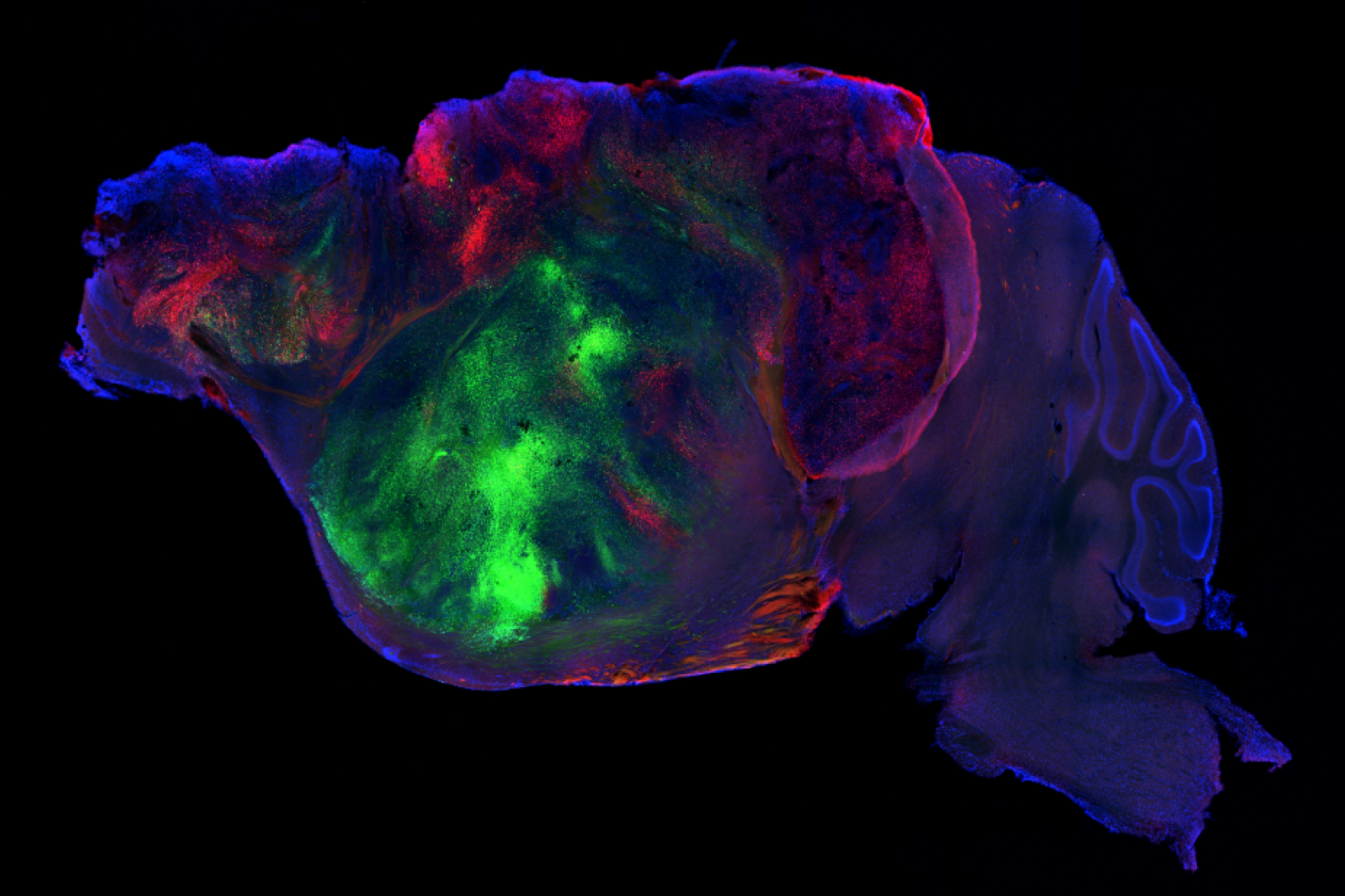 A side view of a "xenocortical" mouse brain, with the grafted human tissue seen in green and red