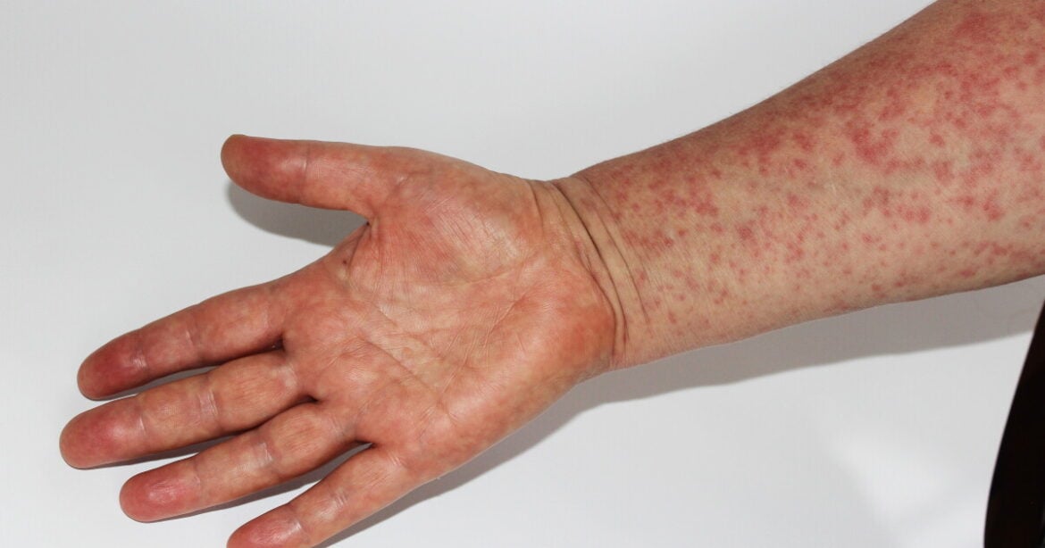 A person's right hand and forearm covered in red measles spots held out in front of a white backdrop