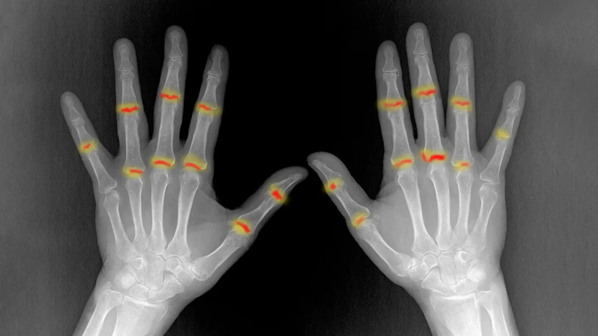 Rheumatoid Arthritis Vulnerability May Be Determined Before Birth