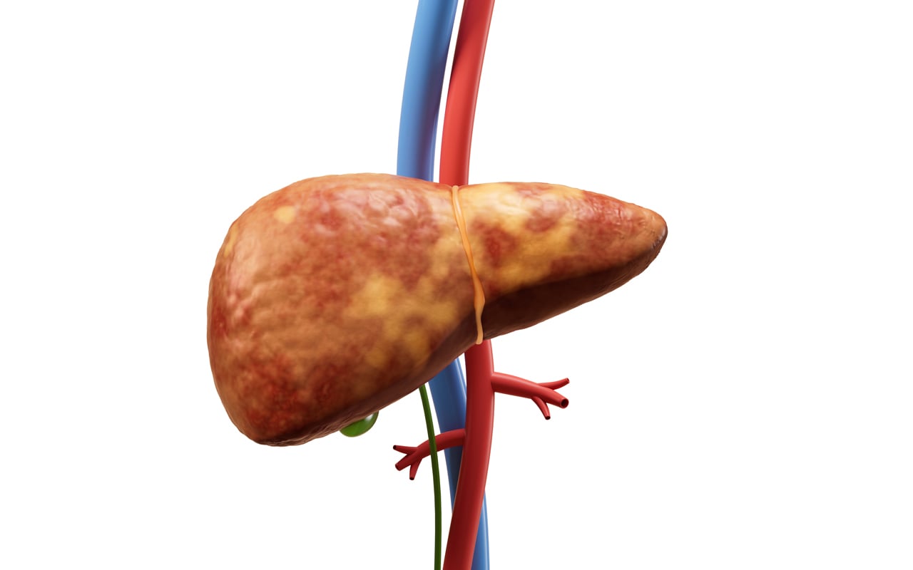 MASLD Cases Rise Among Young Adults Due to Silent Liver Disease