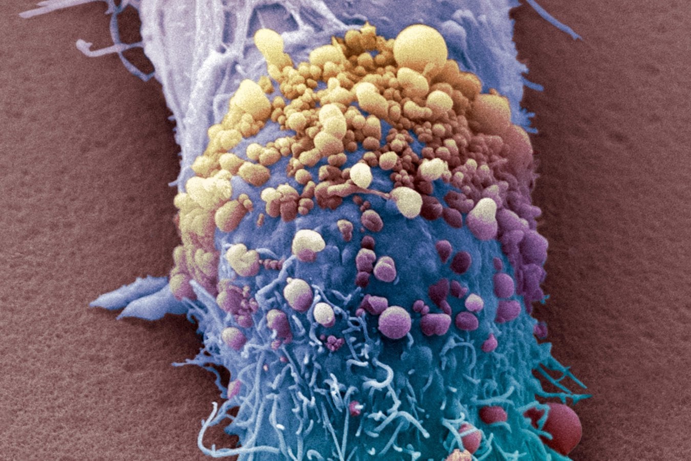 Moderna Cancer Vaccine Cuts Melanoma Risk While Shares Fall