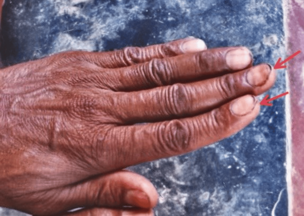 Severe Iron Deficiency Anemia With Koilonychia and Endoscopically Detected in an Elderly Male