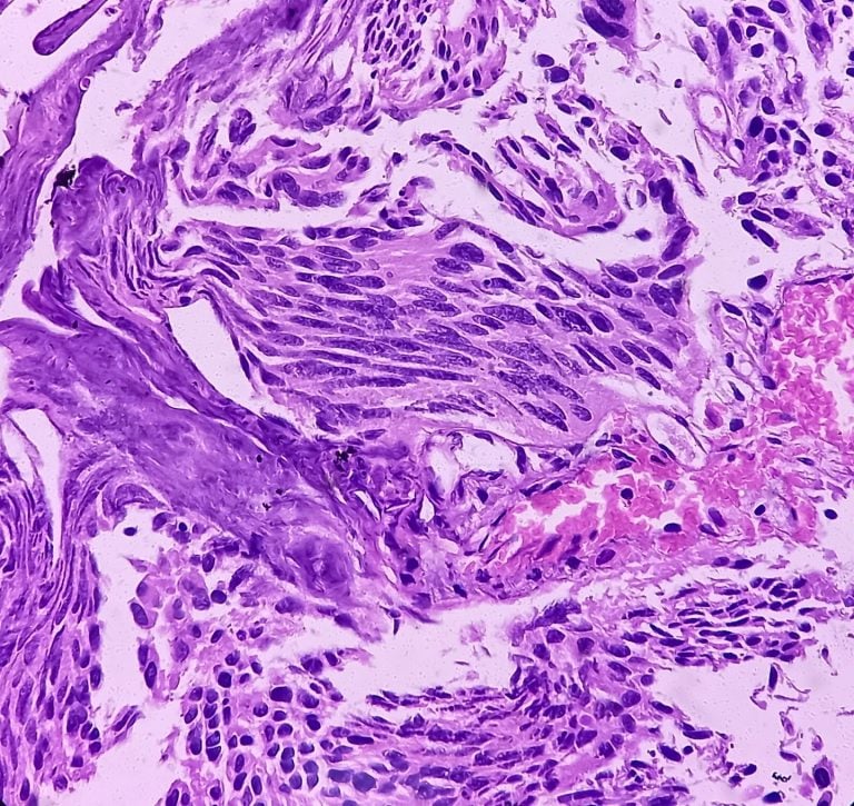 Stanford Medicine Develops Urine Test That Accurately Detects Bladder Cancer