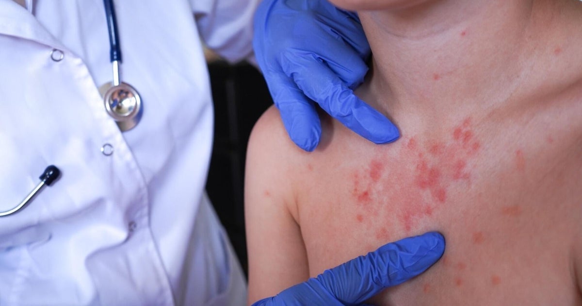 Pennsylvania Reports Sixth Measles-Associated Death