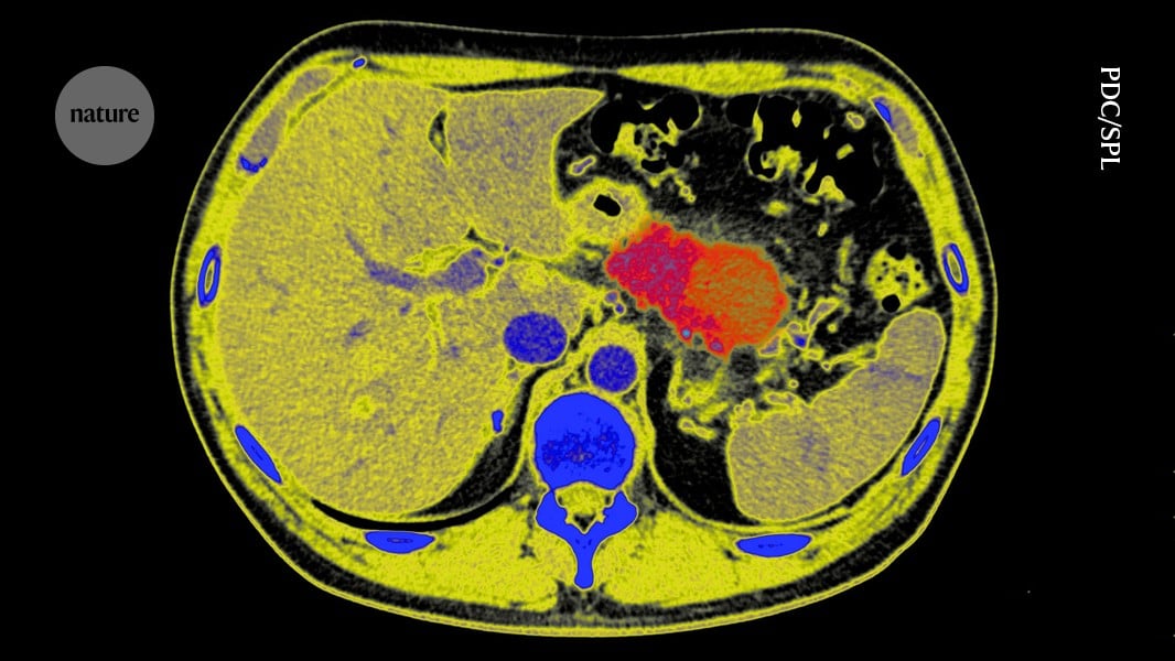 NYU Langone Researchers Map Pancreatic Cancer Evolution