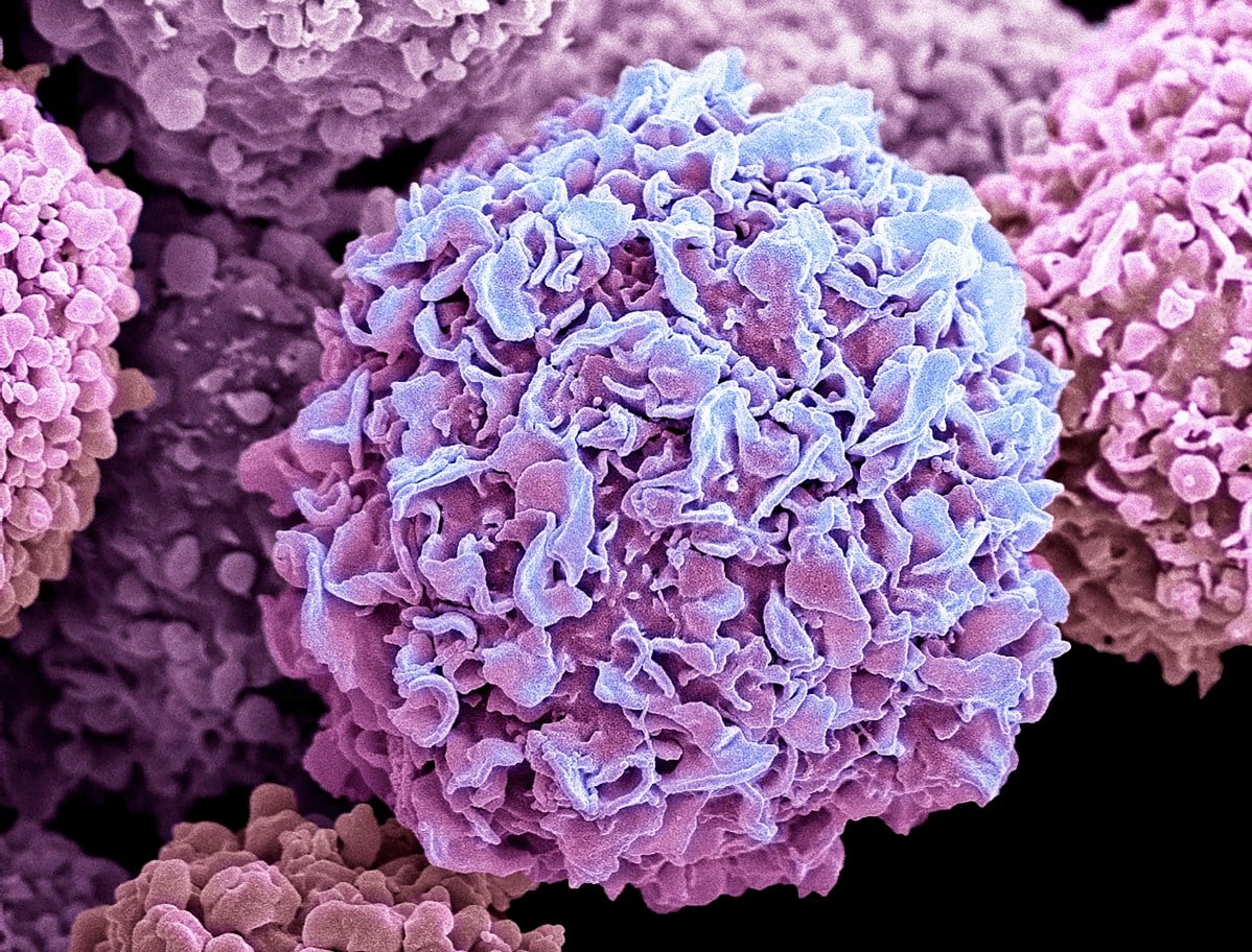Seven Cancer Types Rise in Adults Under 50 in England, WCRF Analysis Finds
